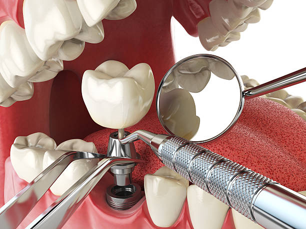 Best Emergency Wisdom Teeth Removal in Bonsall, CA